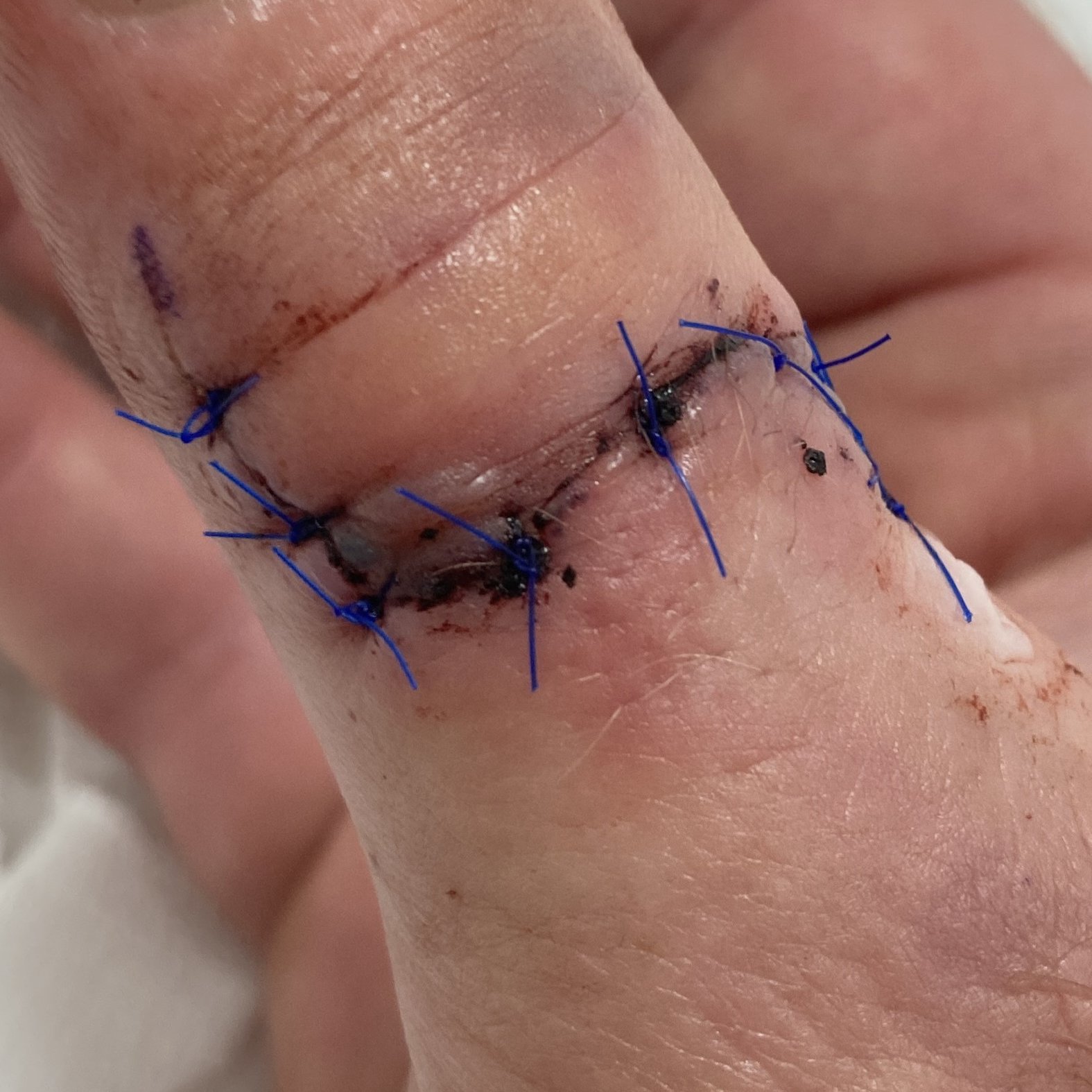 Foto 6: Wunde beim ersten Verbandwechsel nach der OP