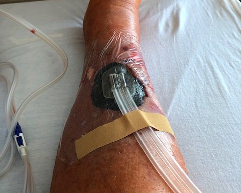 Vakuum-Therapie: Mit Unterdruck die Wundheilung fördern