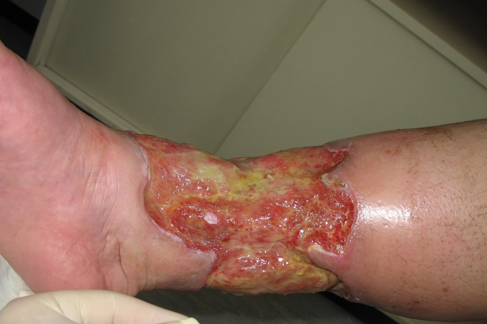 Tiefer Gamaschenulkus