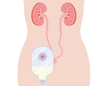 Urostoma: 7 Dinge, die Pflegekräfte wissen sollten