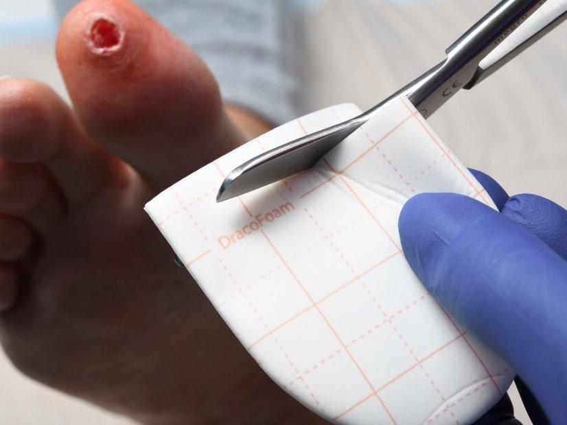 Diabetisches Fußsyndrom, Wundversorgung mit Dracofoam Zehenkappe