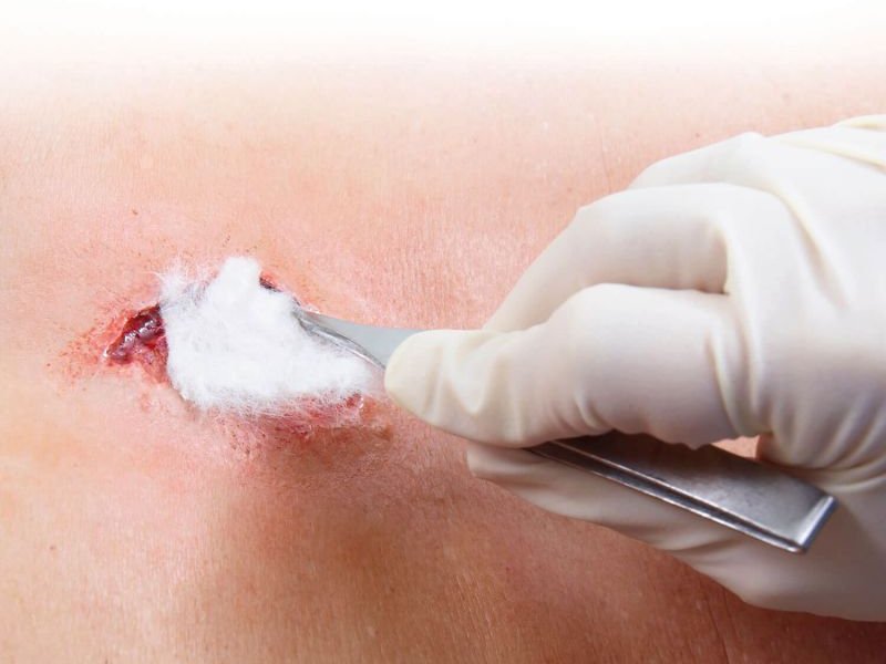 Dracoalgin, Alginatverband auf Wunde