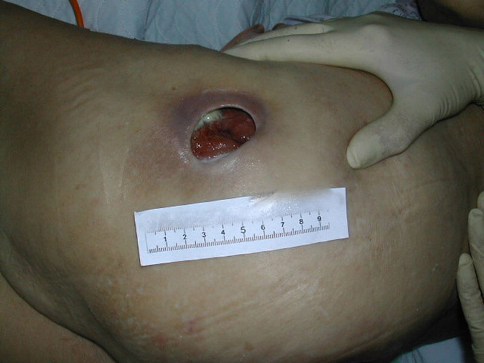 Tiefe Wunde an der Hüfte