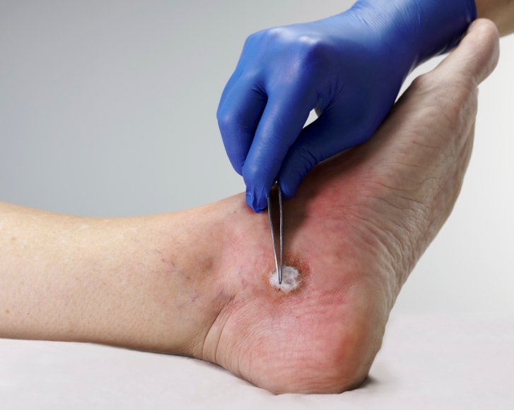 Dracoalgin, sterile Versorgung einer Fußwunde