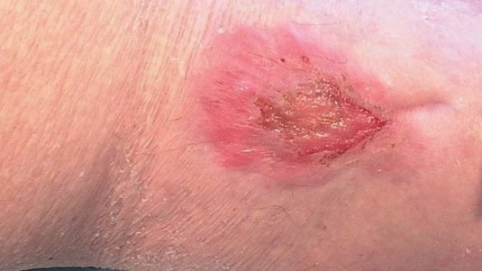 Fallbeispiel: Ulcus cruris venosum mit leichter pAVK