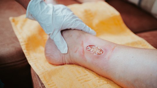 Update – Leitlinie „Diagnostik und Therapie des Ulcus cruris venosum“ und ihre Bedeutung für die Wundversorgung
