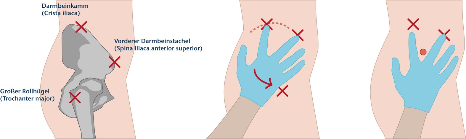 Injektionsstelle Gesäßmuskel Abbildung