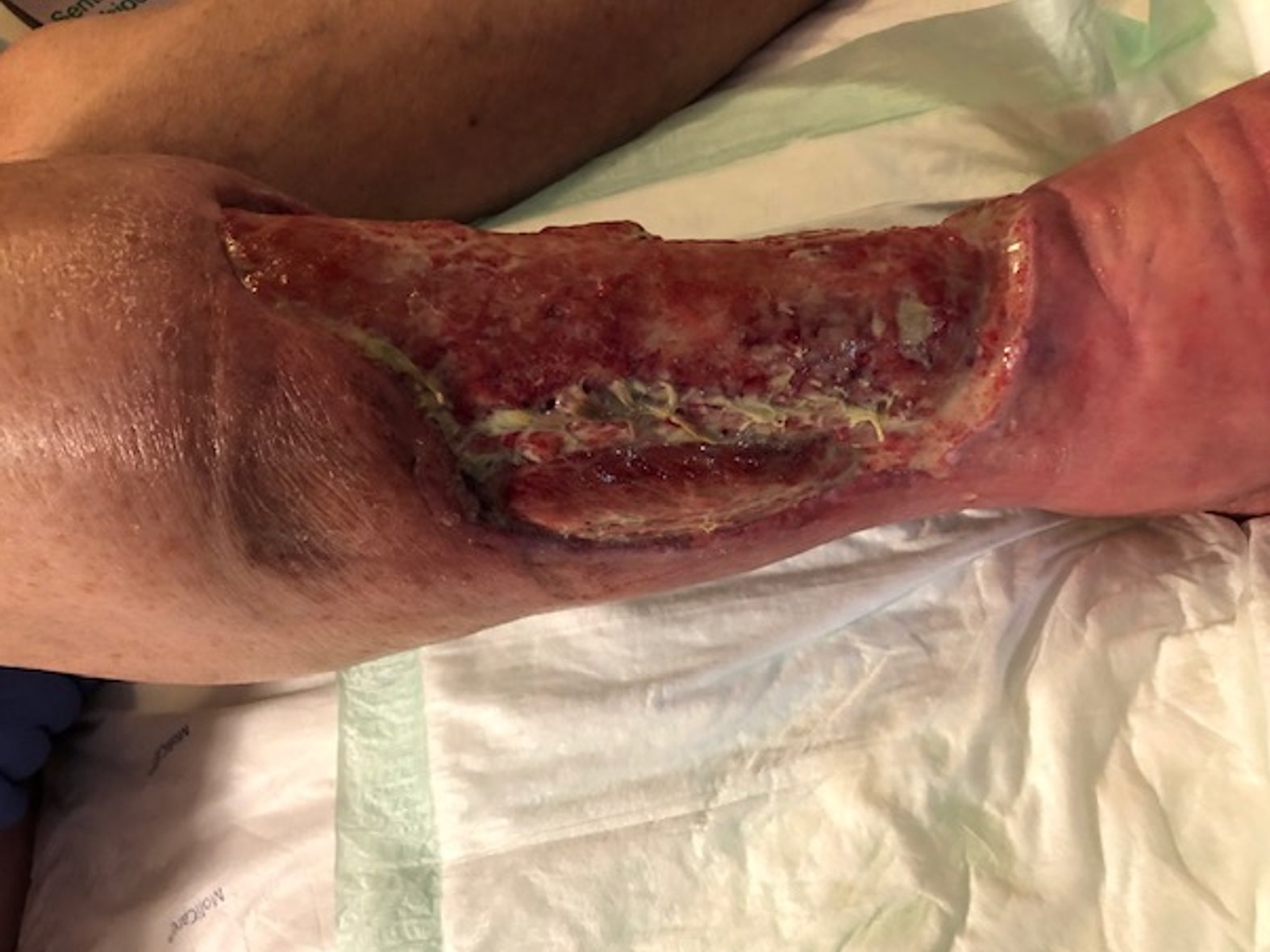 Ulcus am rechten Unterschenkel 3