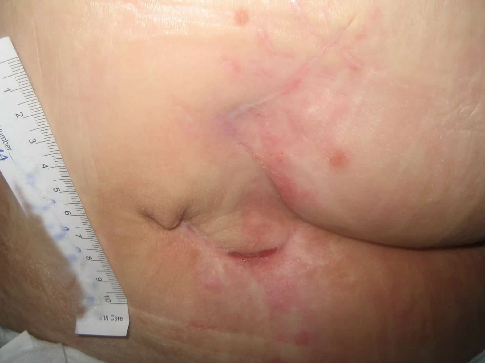 Dekubitus Lappenplastik Narbe