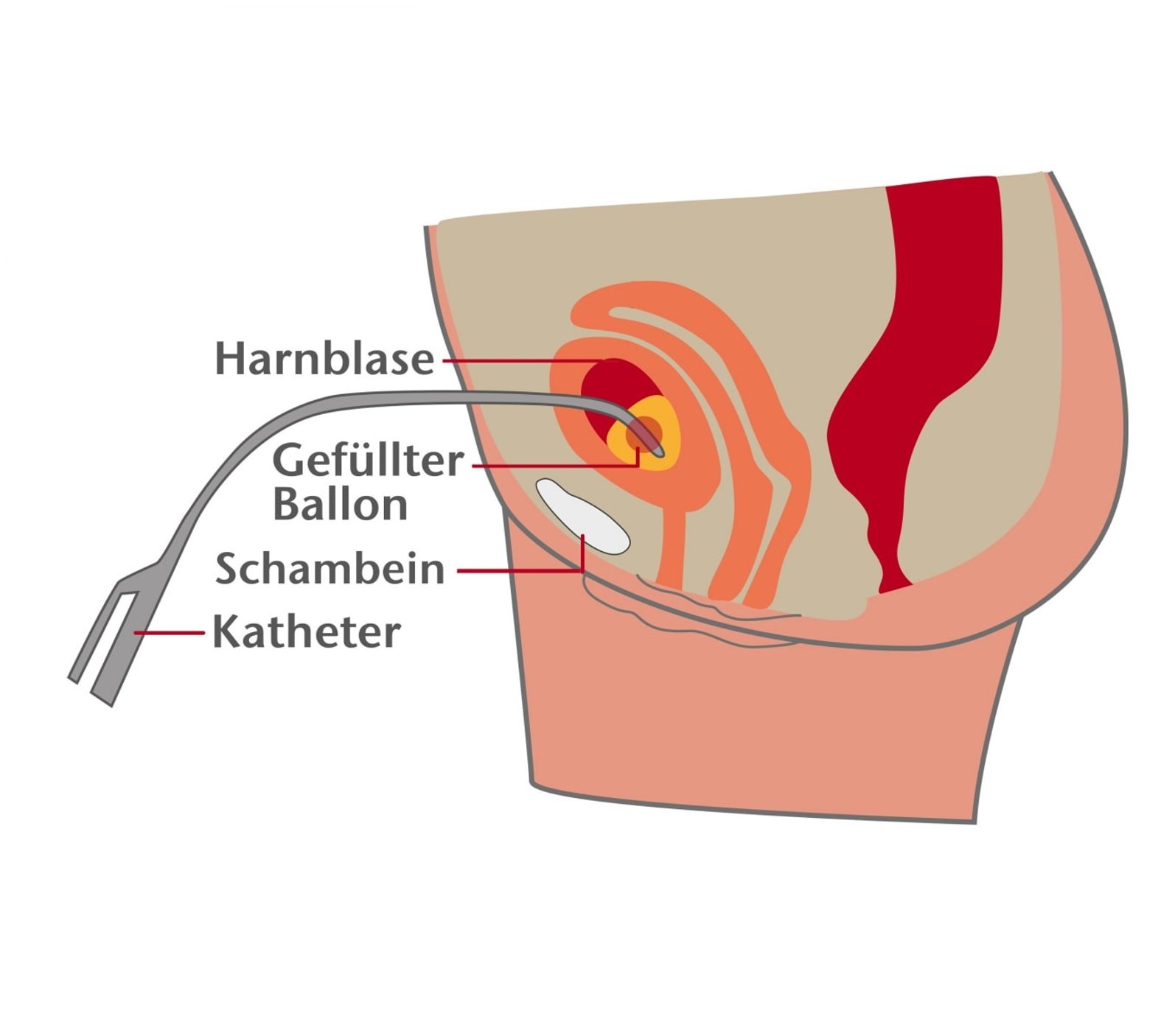 darstellung-suprapubischer-blasenkatheter