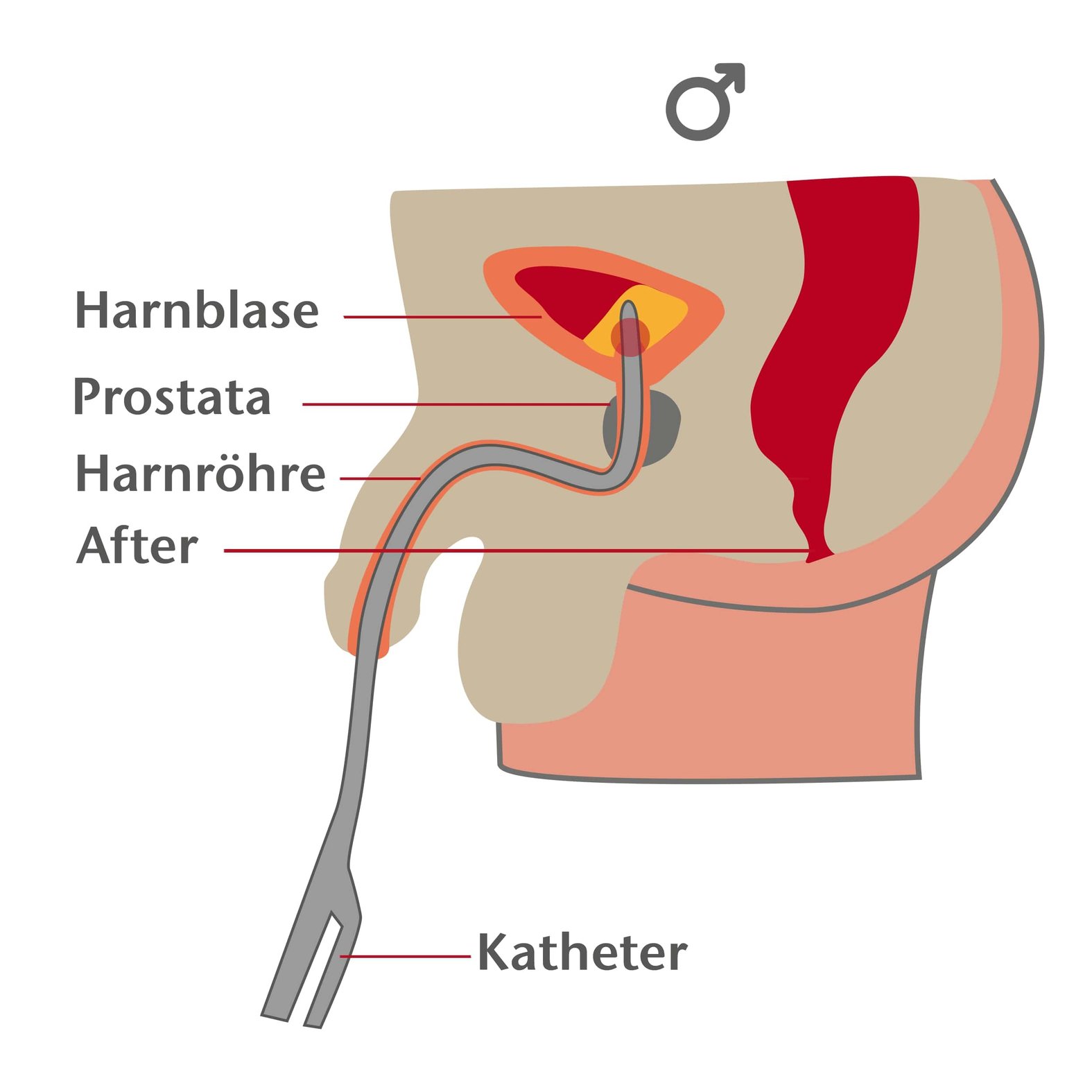 blasenkatheter-legen-mann