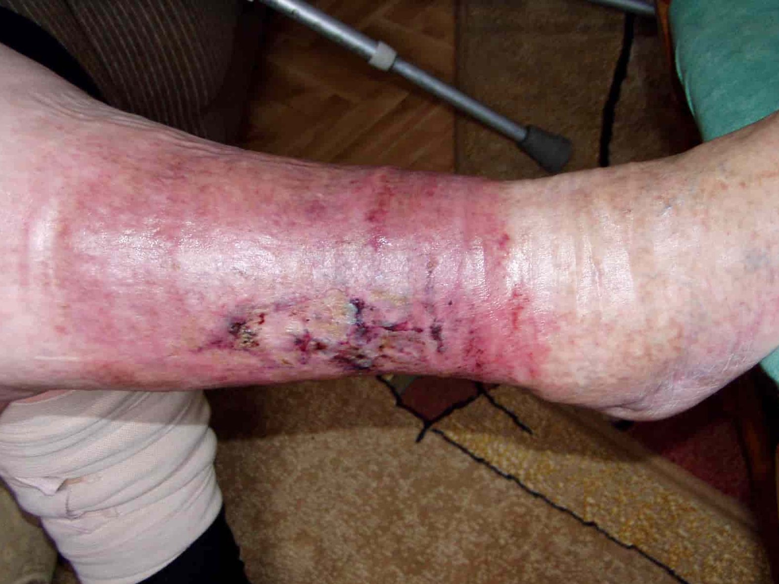 Fallbeispiel Ulcus cruris venosum