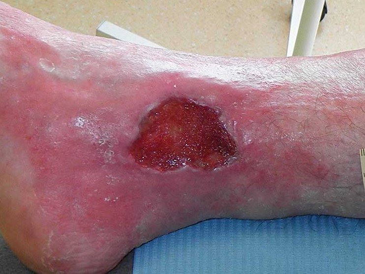 Ulcus cruris arteriosum