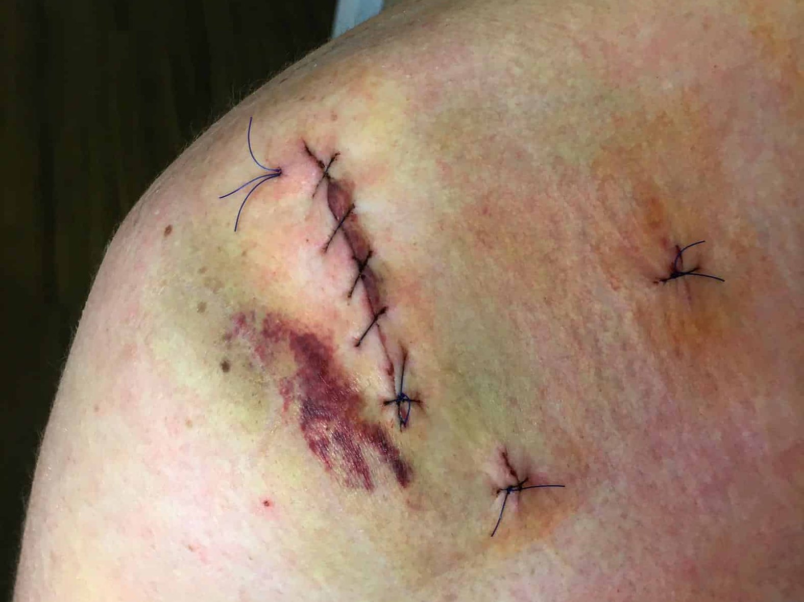 OP-Wunde an der Schulter