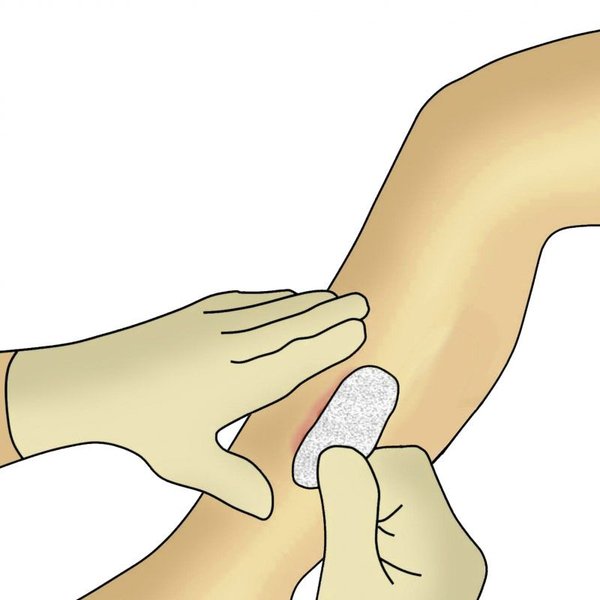 Dracoalgin Verbandwechsel Schritt 4