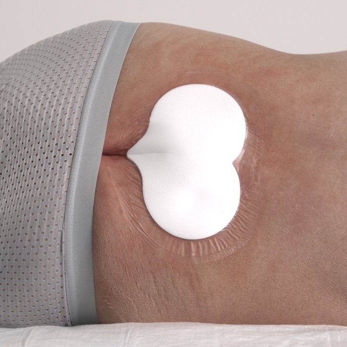 Versorgung eines Sakraldekubitus mit DracoFoam Sakral