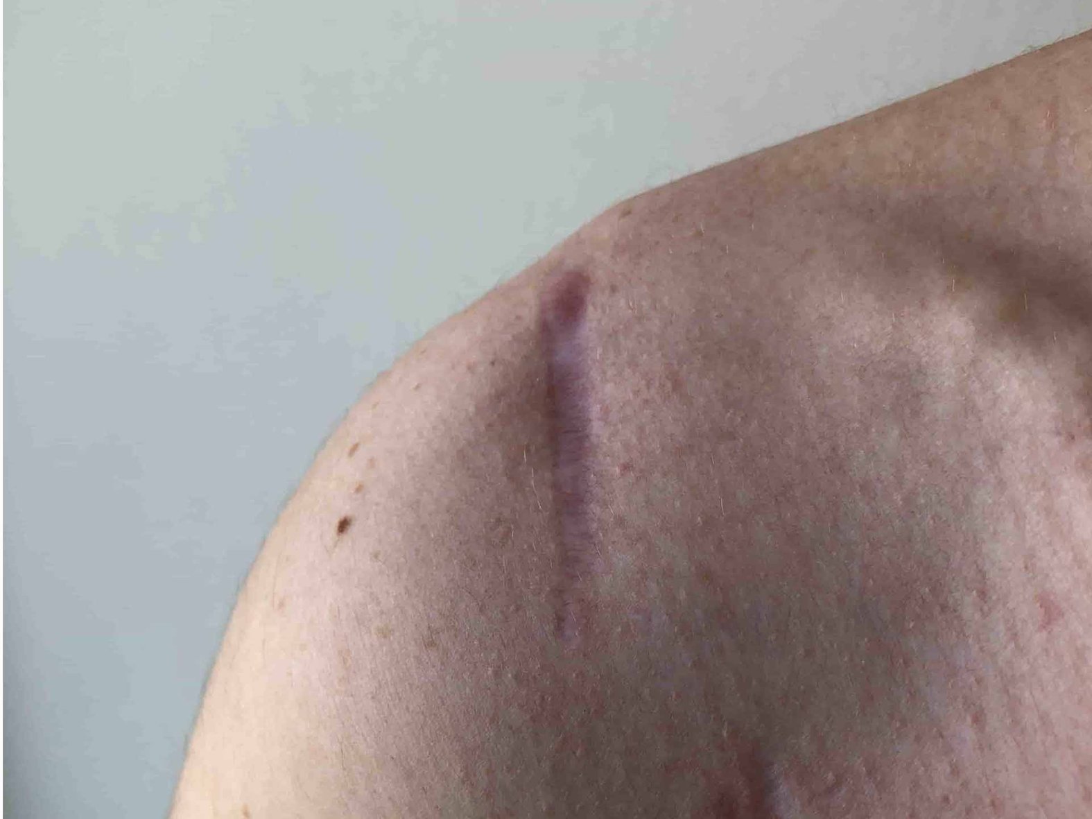 Abgeheilte OP-Wunde mit zurückgebliebener Narbe