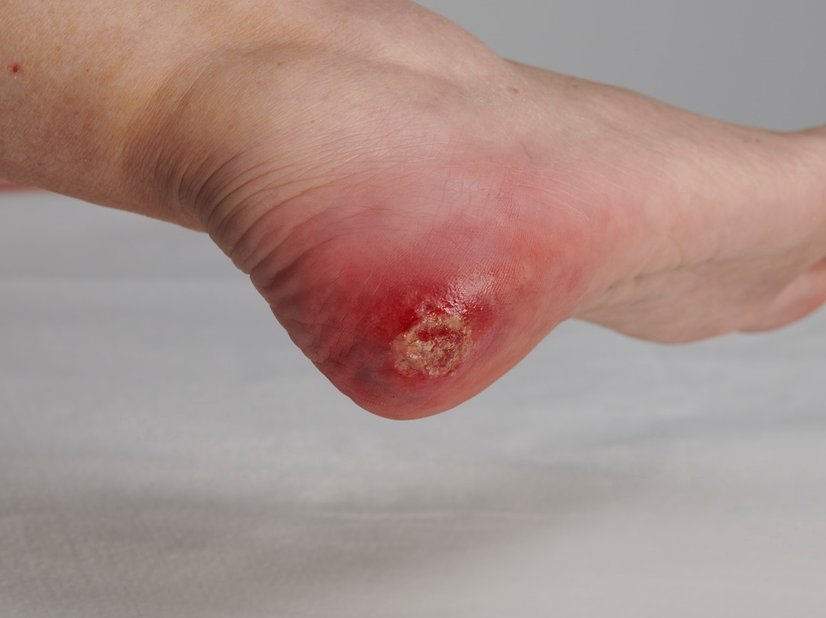 Infizierte Wunde an der Ferse