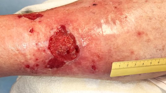 Fallbeispiel: Schlecht heilende Wunde durch Plattenepithelkarzinom