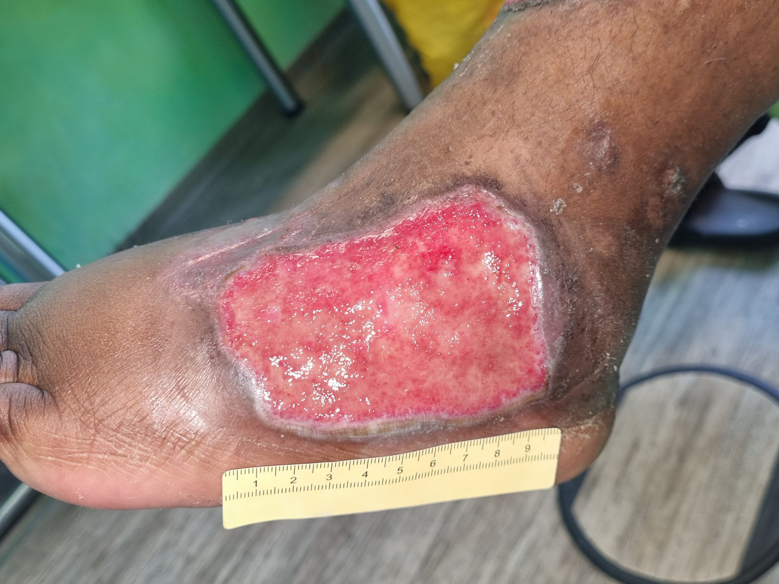 Foto 4: Wunde am linken Fuß lateral ohne Fibrin (Tag 58)