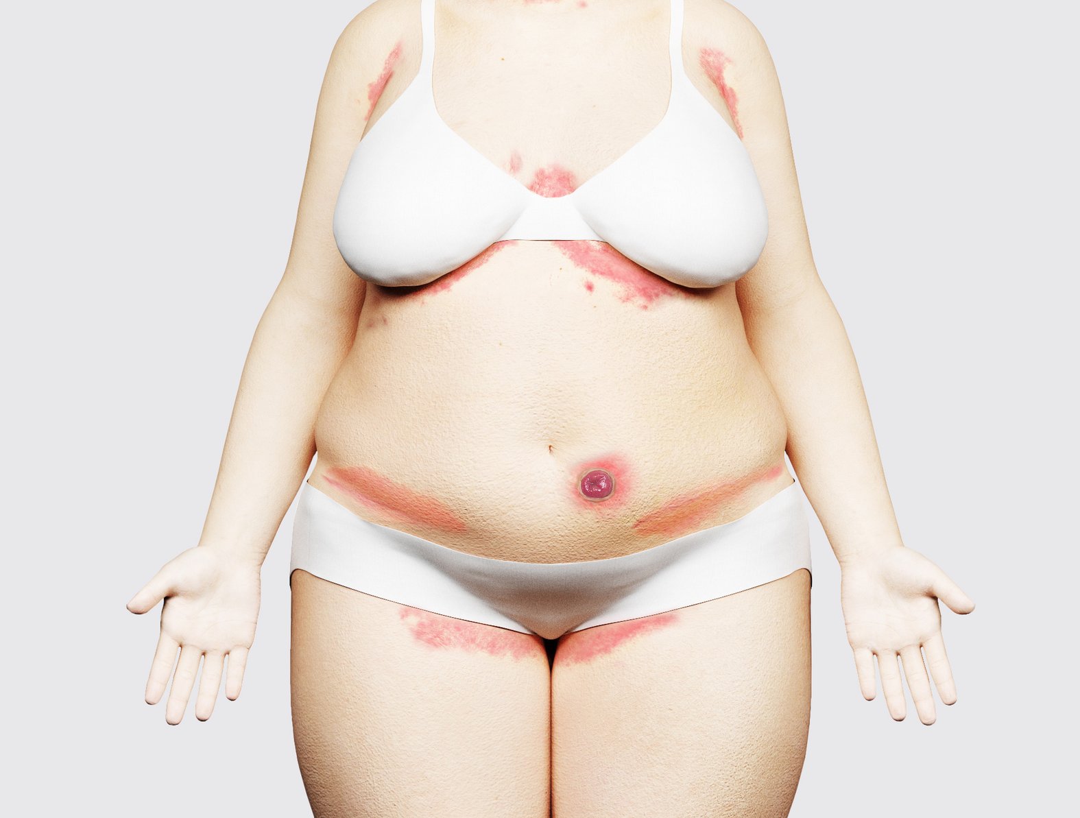 Flüssigkeits-assoziierte Hautschäden (FAH): Auftreten, Schema