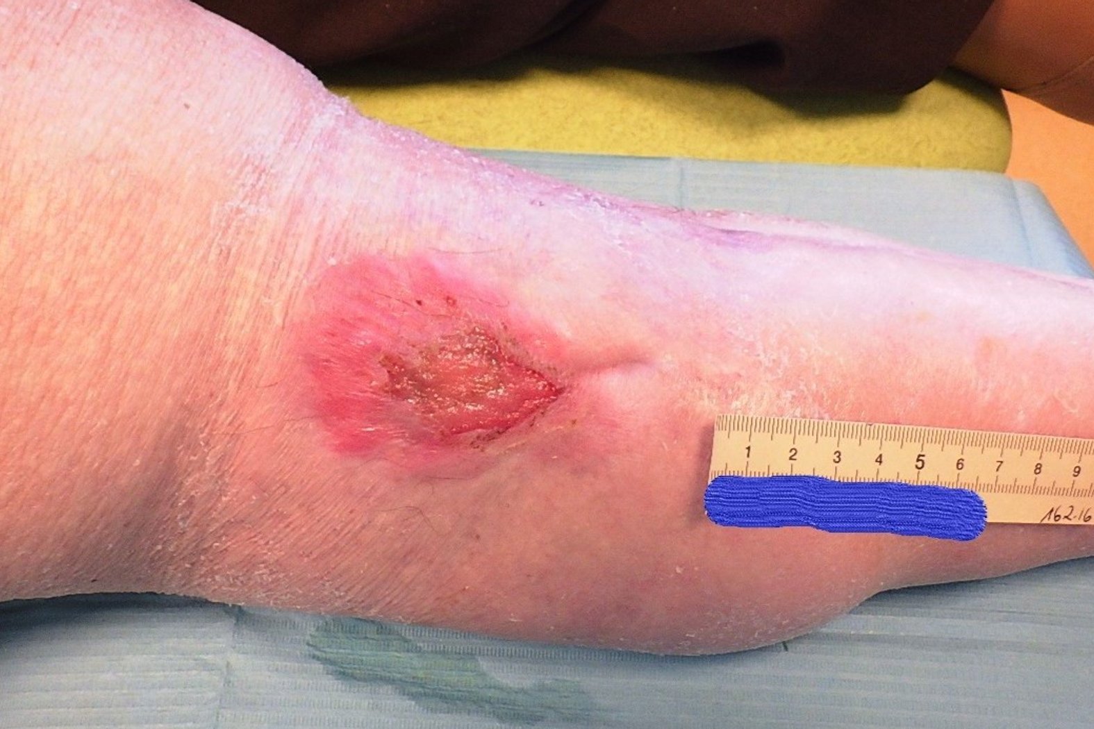 Ulcus cruris venosum, Foto 1