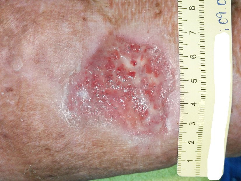 Ulcus cruris venosum, Ausgangssituation