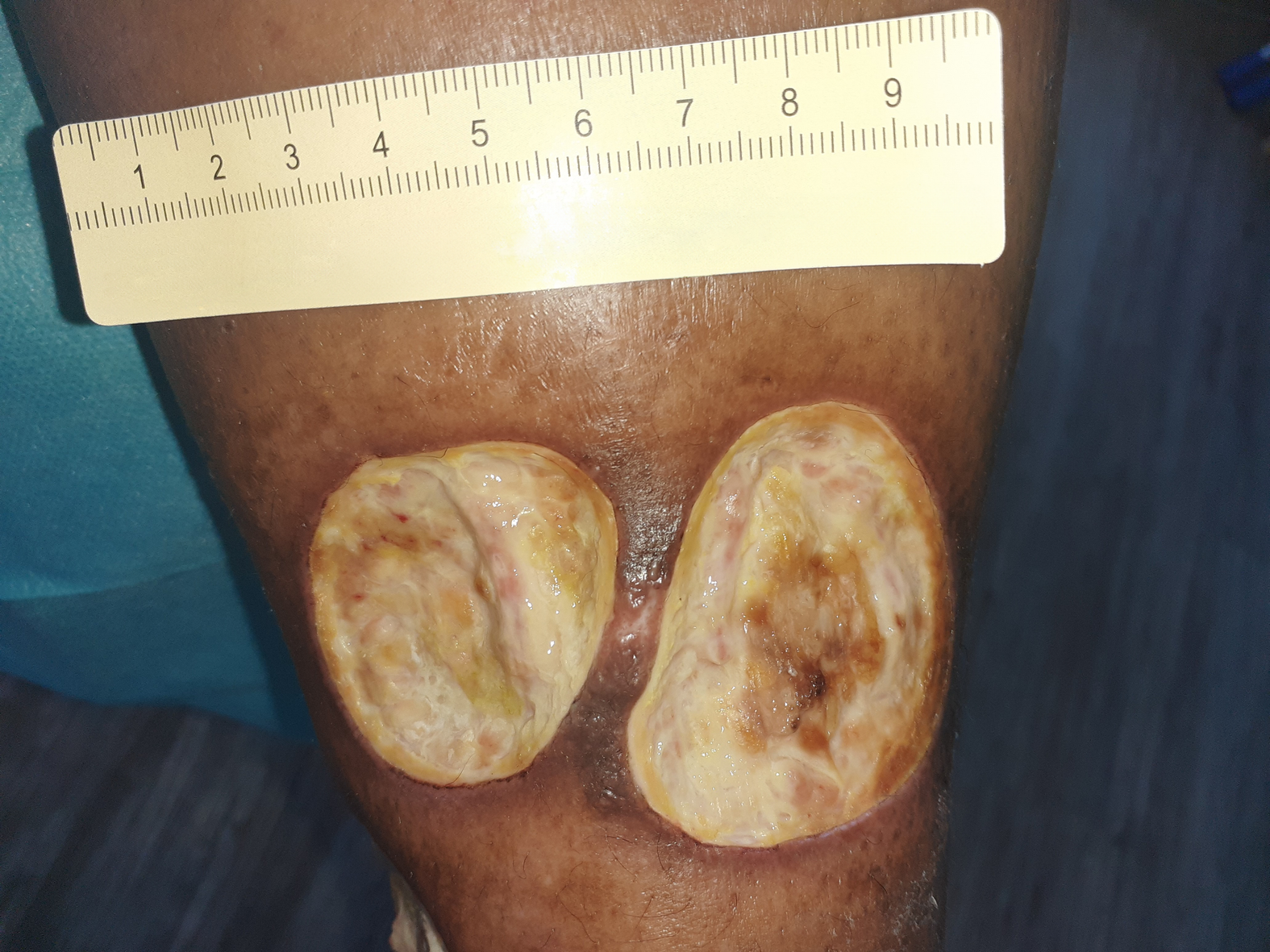 Fallbeispiel Vaskulitis