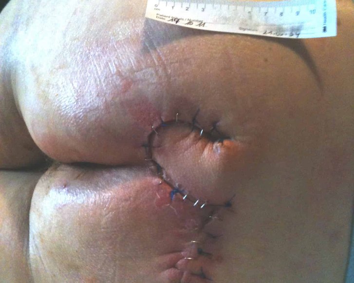 Dekubitus Lappenplastik nach OP