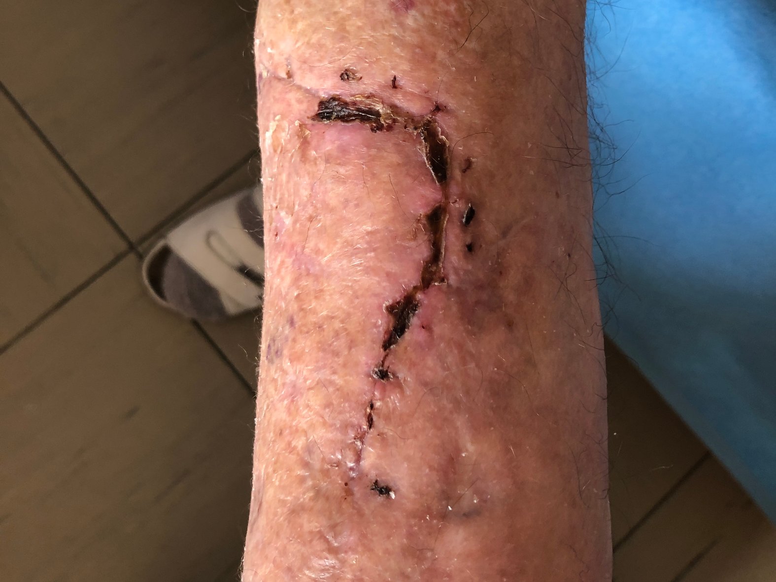 Ablederungswunde, verheilt, bei Altershaut