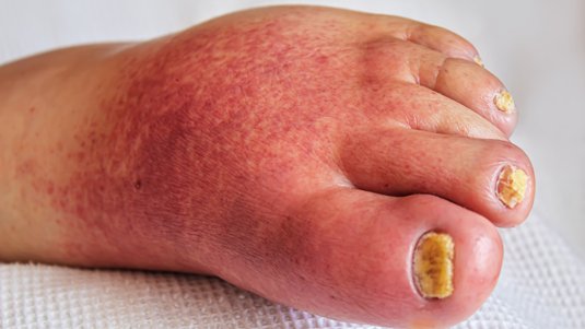 Erysipel – Die flammenartige Hautrötung