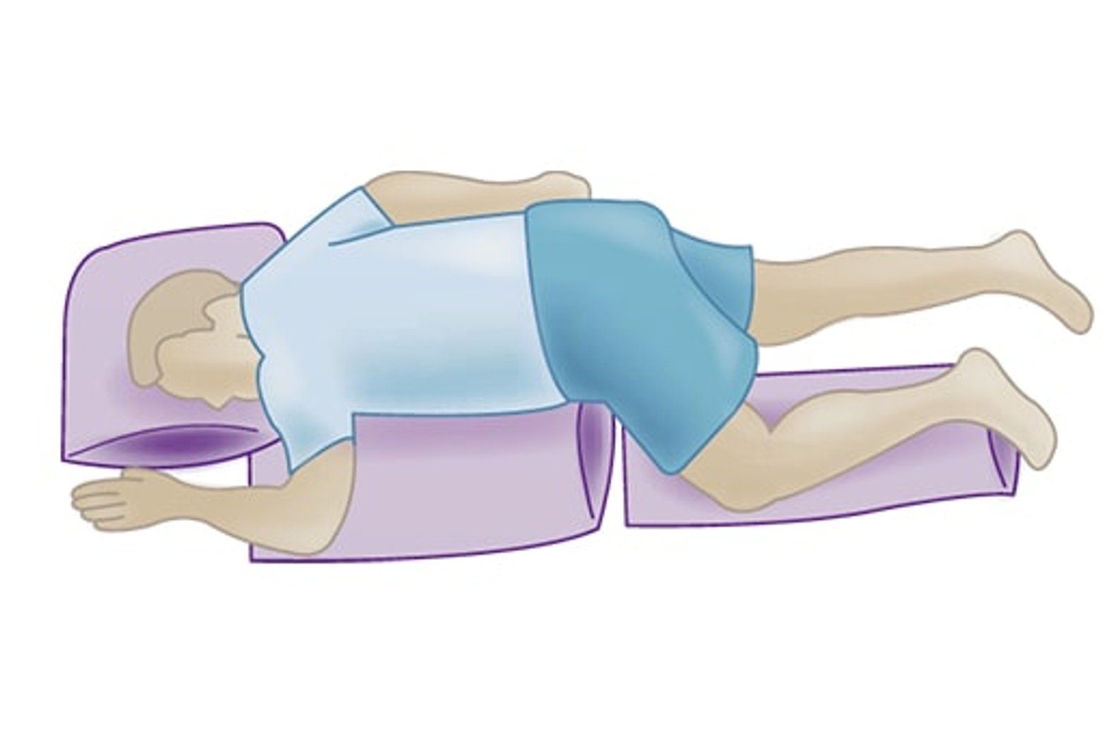 Zeichnung einer 135-Grad Dekubitus Lagerung