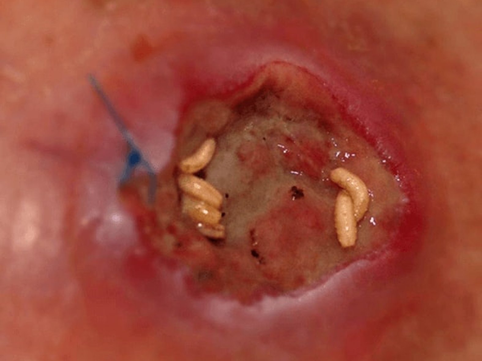 Biochirurgisches Débridement, Madentherapie