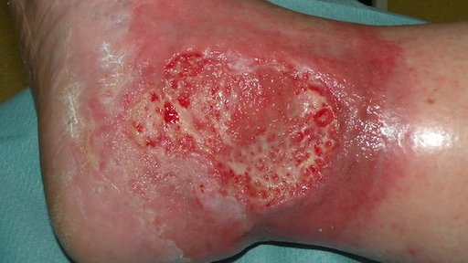 Exsudationsphase am Knöchel