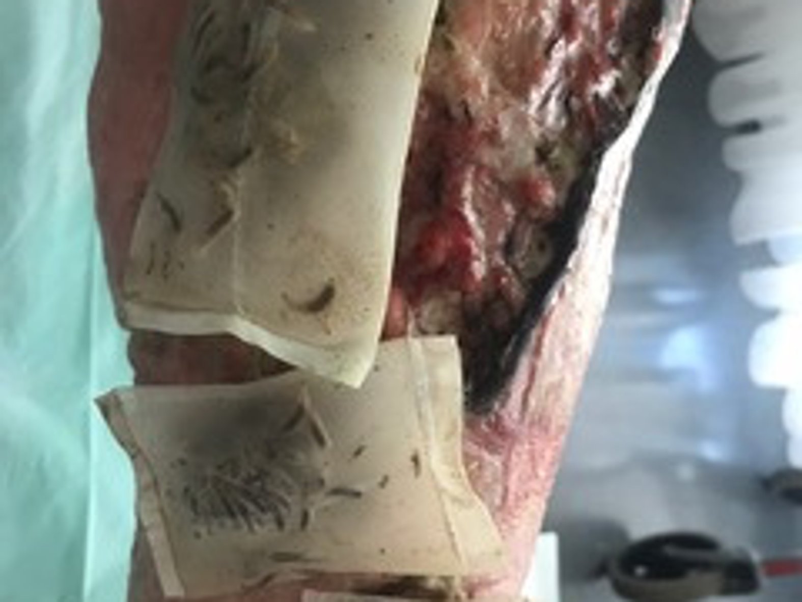 Madentherapie mit BioBag®