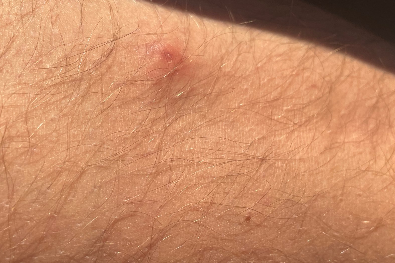 Krätze, Scabies, vereinzelter Ausschlag