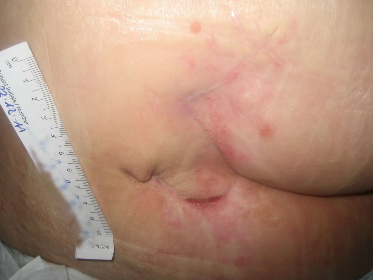 Abgeheilter Sakraldekubitus der Kategorie 4 nach Schwenklappenplastik