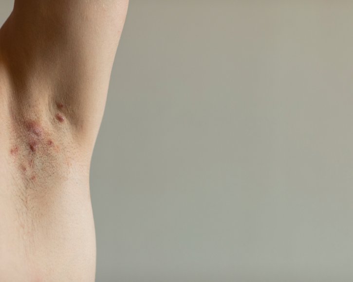 DEWU 2026: Bei einer Acne inversa zählt die frühe Diagnose