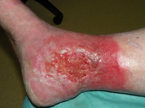 Chronische Wunde am Fußknöchel