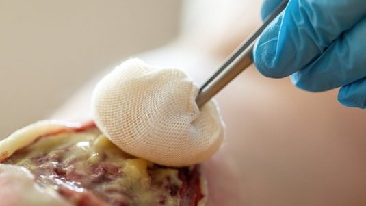 Wundreinigung in der Praxis: Débridement-Methoden und Fallbeispiele