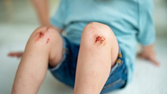 Akute Wunden bei Kindern – Apothekentipps geben Sicherheit