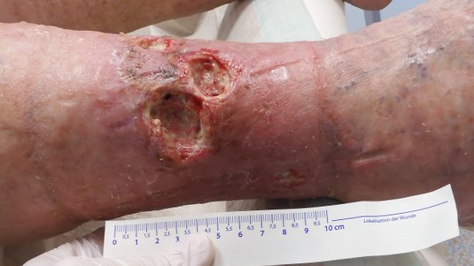 Fallbeispiel: Venöses Ulcus cruris – zwischen Diabetes, Parkinson und chronischer Wunde