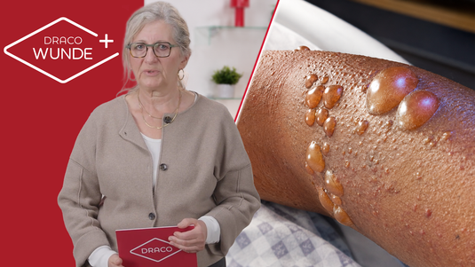 Seltene Erkrankungen verstehen: Bullöses Pemphigoid