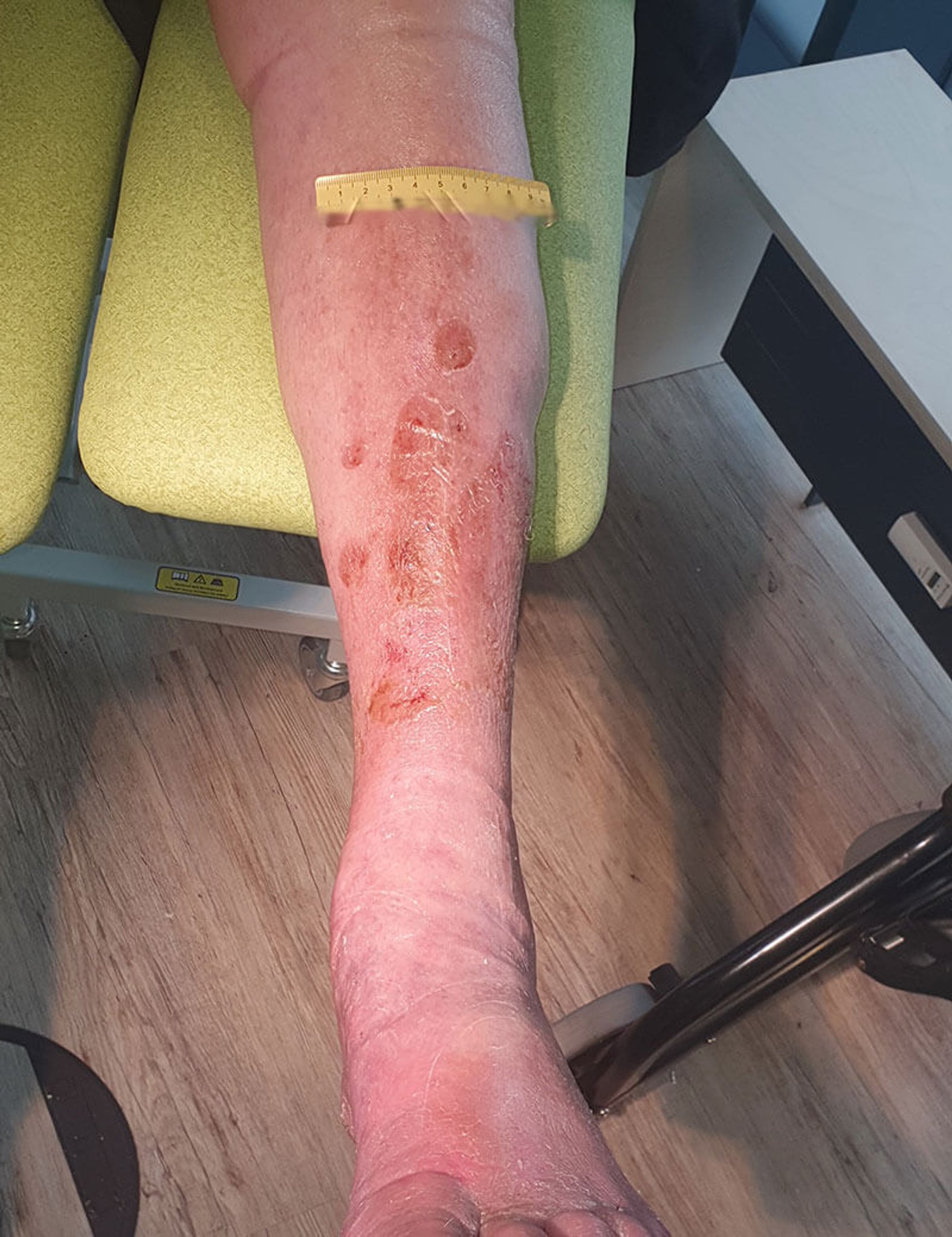 Ulcus cruris venosum nach Trauma 