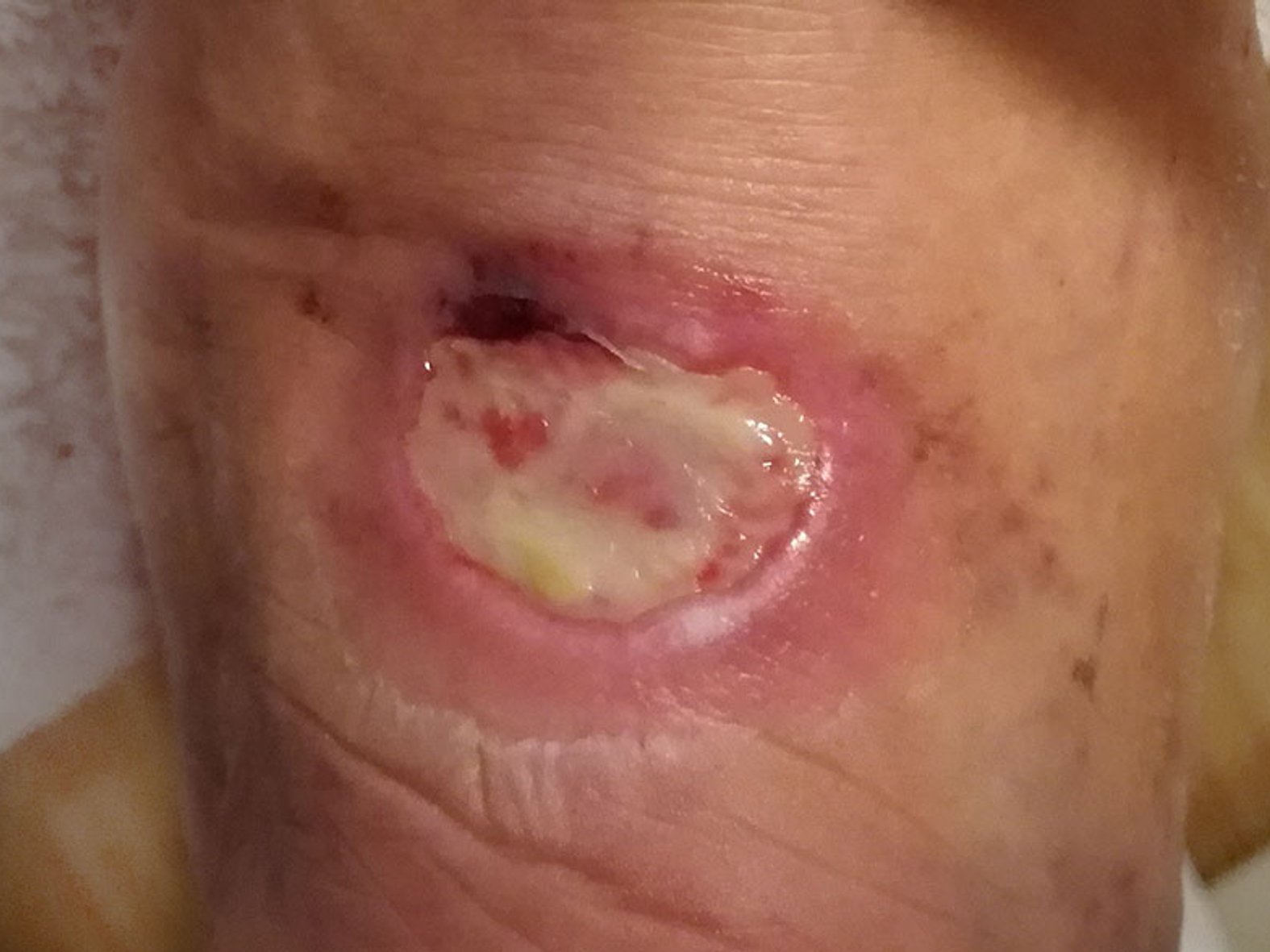 Infektfibrin, Wunde Achilessehne