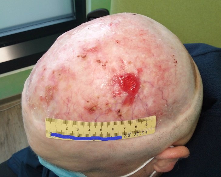 Wundheilungsstörung nach Hautkrebs