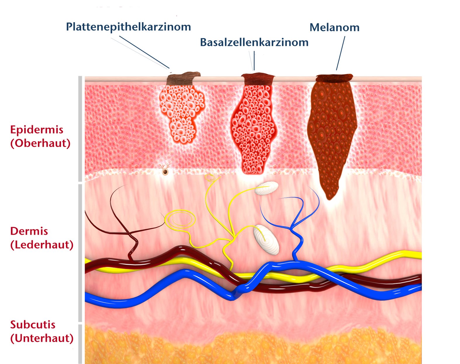 Typen von Hautkrebs und betroffene Hautschichten, Schema