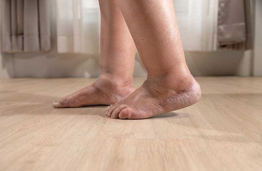 Ulcus cruris venosum (UCV) erkennen und versorgen