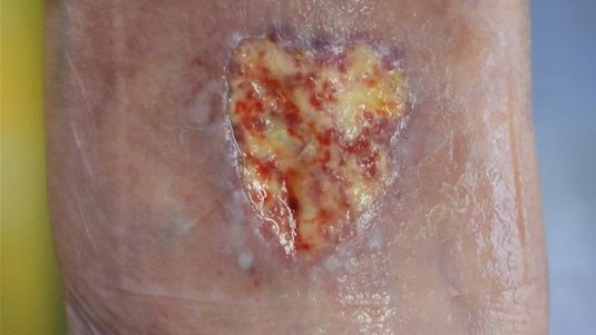 Fallbeispiel: Ulcus cruris arteriosum nach Verletzung mit Wundheilungsstörung