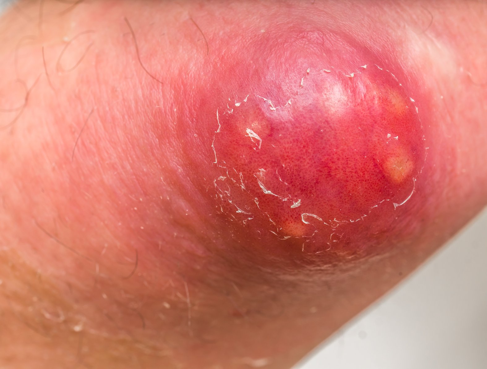 Furunkel am Ellbogen, sichtbare Eiterherde